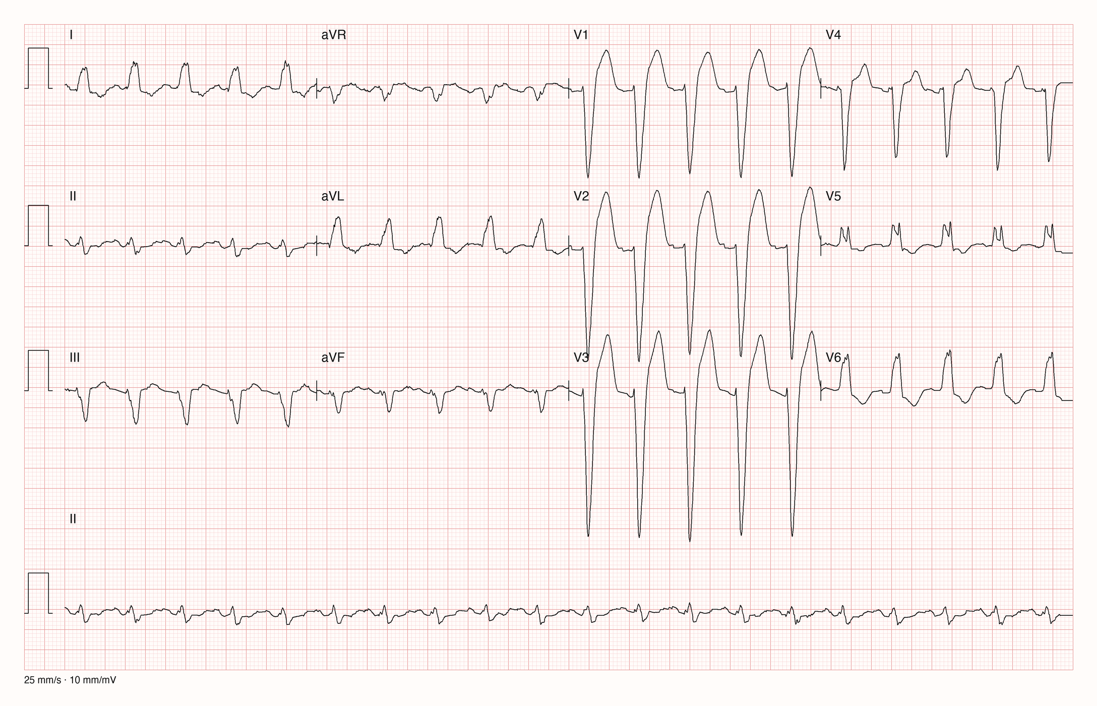 12-Kanal-EKG eines 55-jährigen Mannes mit Tachykardie und breiten QRS-Komplexen
