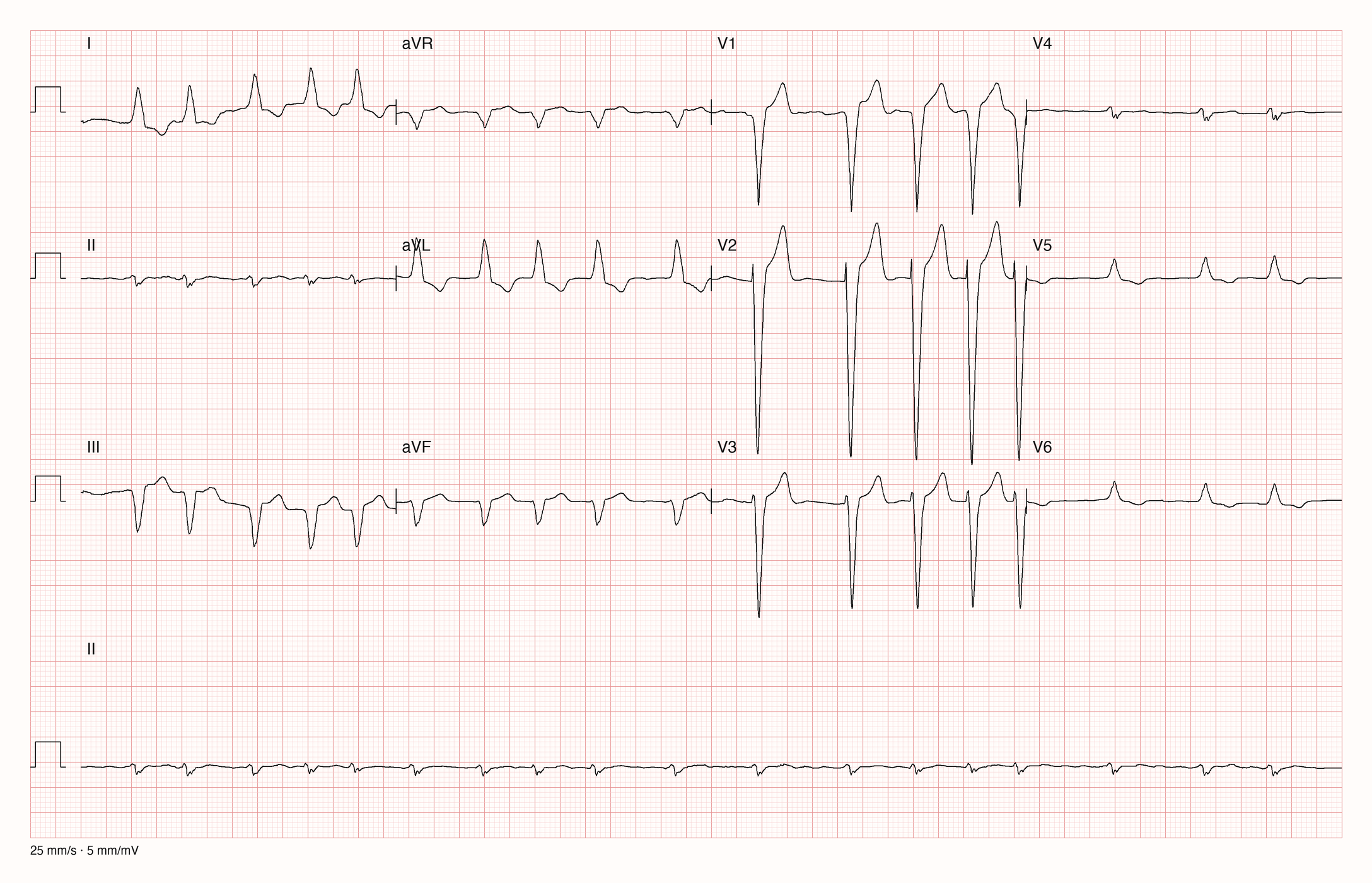 12-Kanal-EKG einer über 90-jährigen Patientin mit unregelmäßiger Tachykardie und breiten QRS-Komplexen