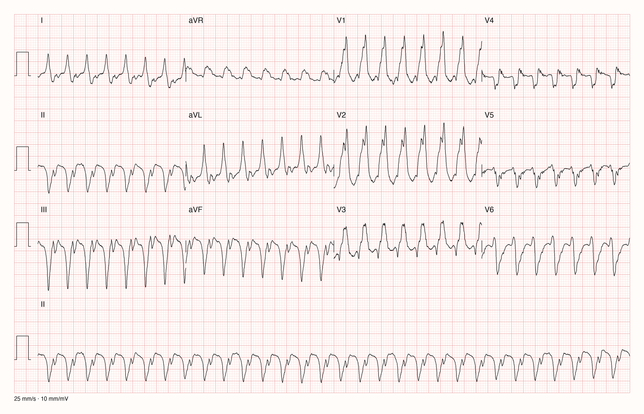 12-Kanal-EKG einer Patientin mit regelmäßiger Tachykardie