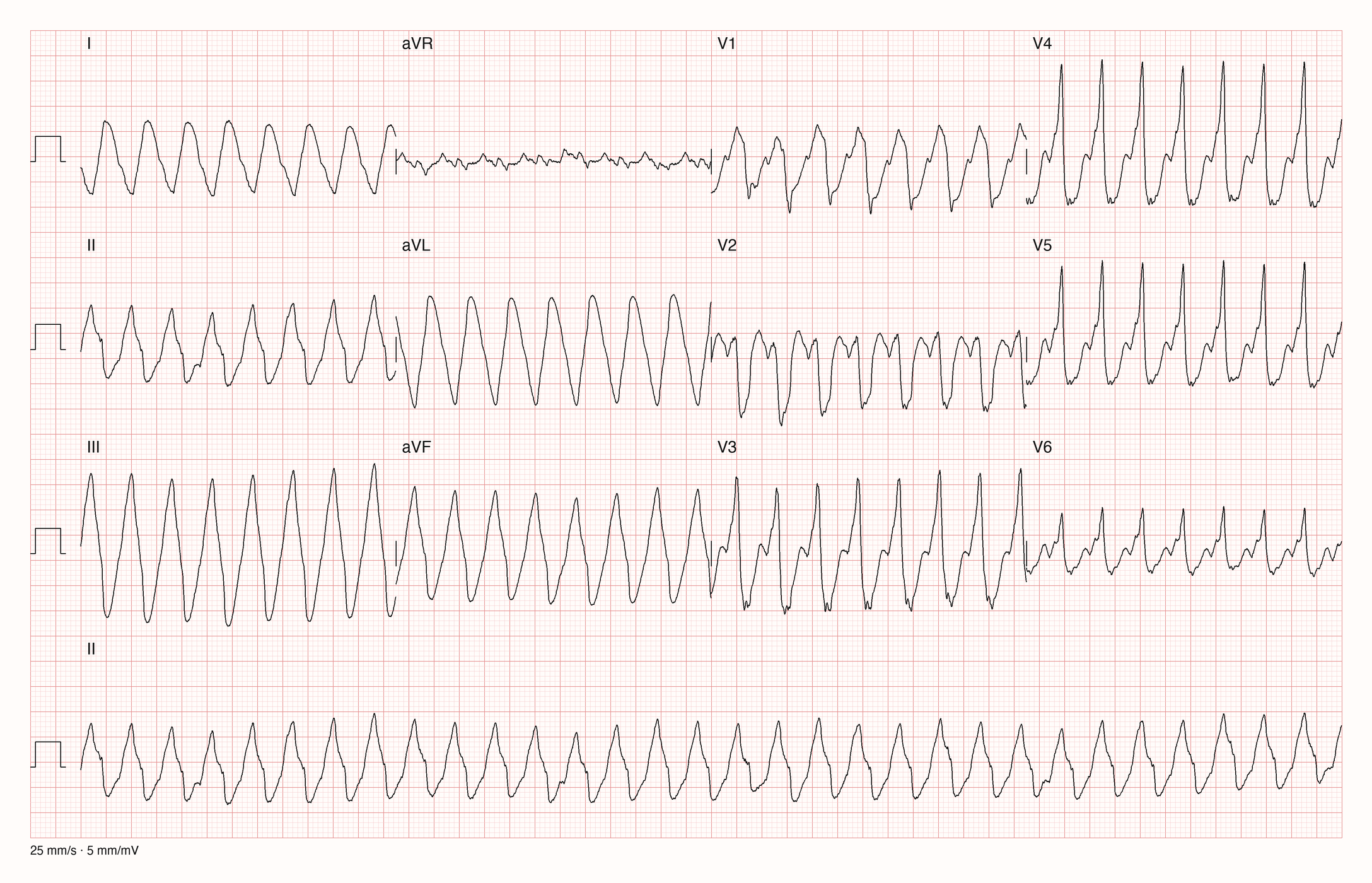 12-Kanal-EKG eines 37-jährigen Mannes mit regelmäßiger Tachykardie, halbe Verstärkung
