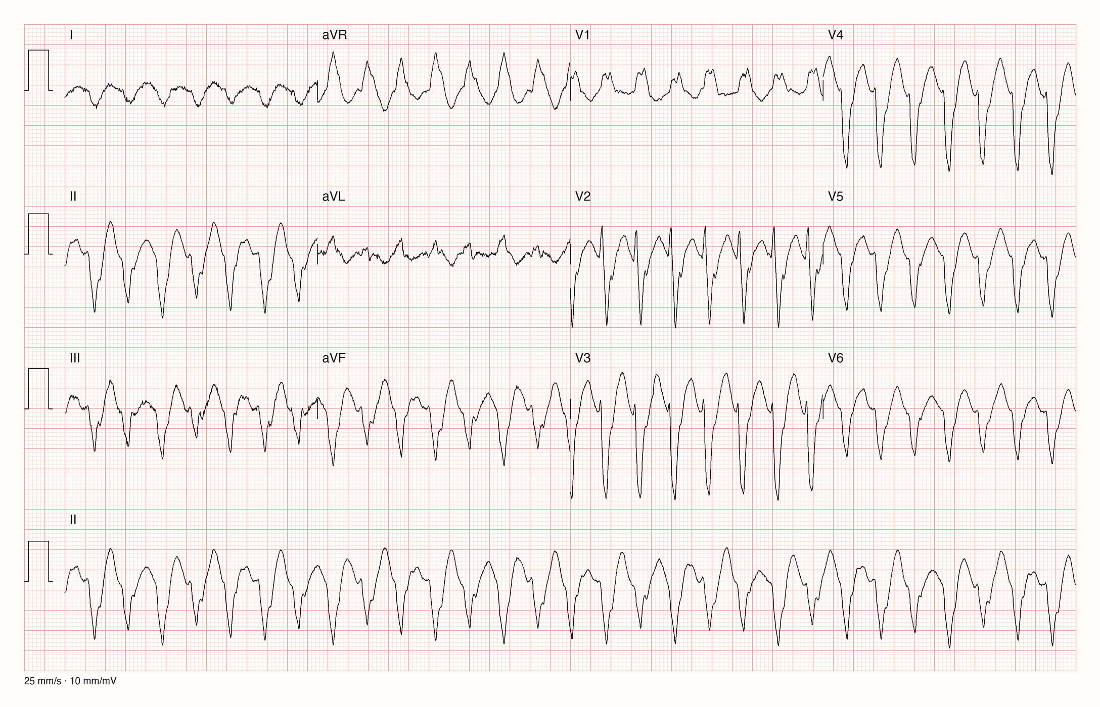 12-Kanal-EKG einer 41-jährigen Frau mit schneller, regelmäßiger Tachykardie