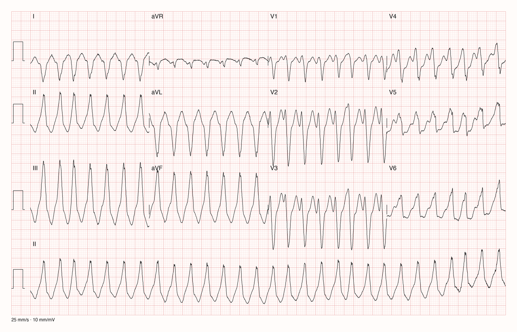 12-Kanal-EKG einer Patientin mit regelmäßiger Tachykardie