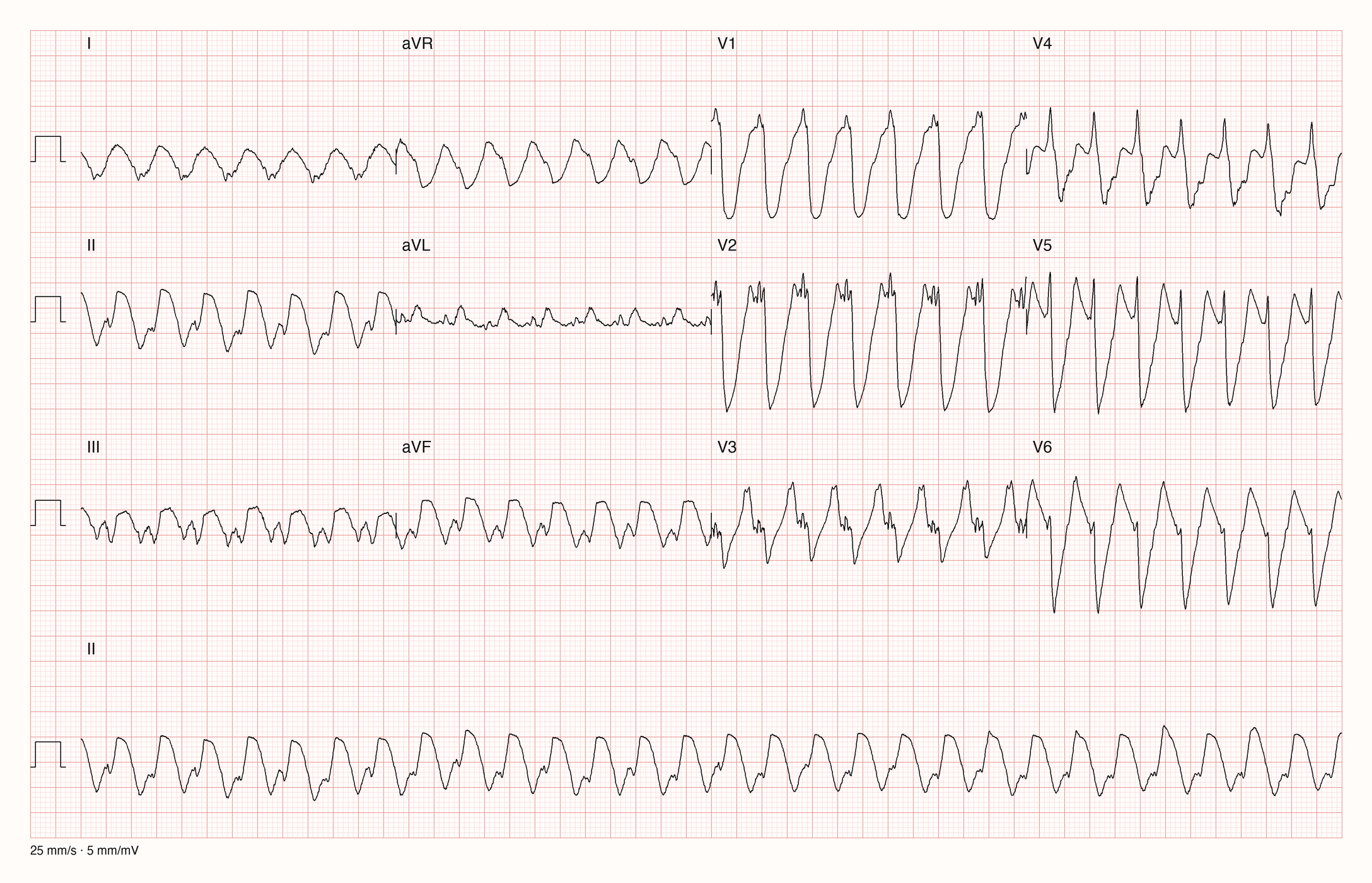 12-Kanal-EKG eines Patienten mit regelmäßiger Tachykardie, halbe Verstärkung