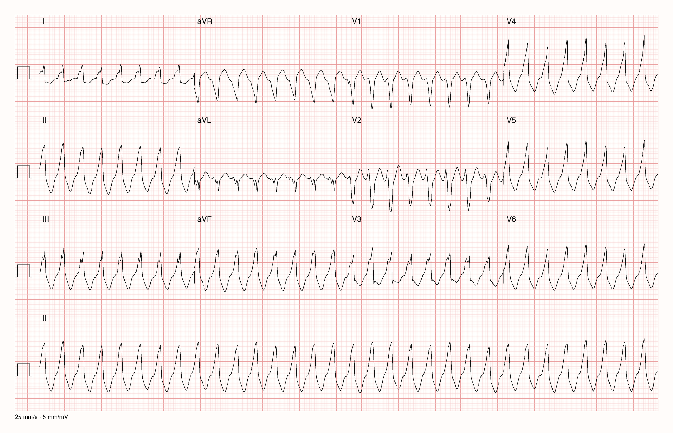 12-Kanal-EKG eines Patienten mit schneller, regelmäßiger Tachykardie, halbe Verstärkung