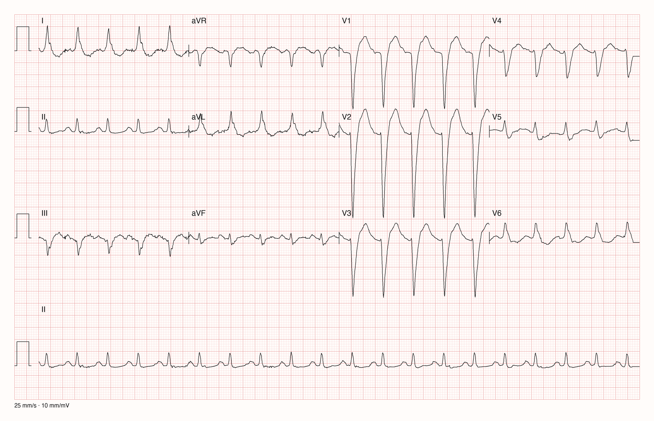 12-Kanal-EKG einer über 90-jährigen Patientin mit Tachykardie und breiten QRS-Komplexen