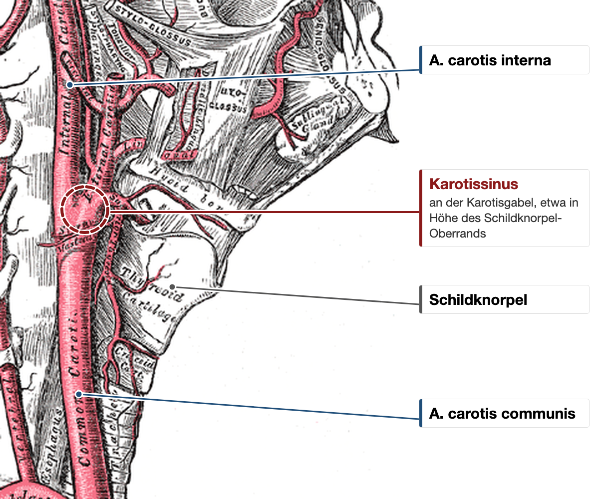 Anatomische Zeichnung der rechten Halsseite: Die A. carotis communis teilt sich etwa in Höhe des Schildknorpel-Oberrands in A. carotis interna und externa; der Karotissinus an der Gabel ist rot gestrichelt markiert