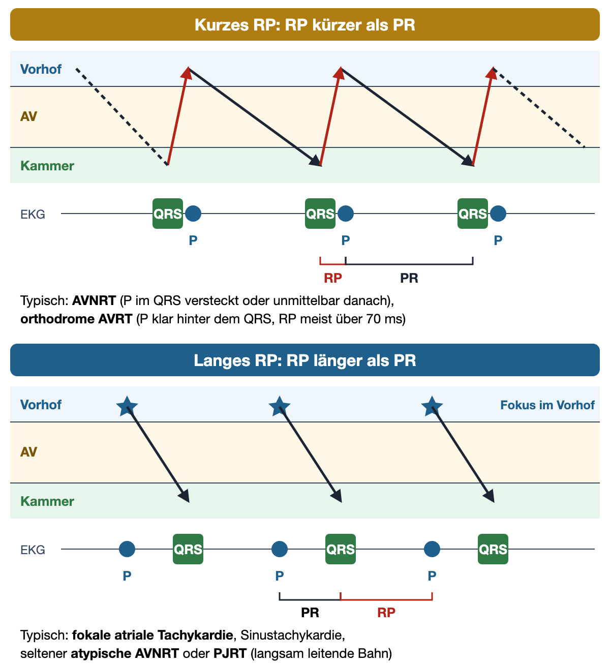 Leiterdiagramm mit den Ebenen Vorhof, AV und Kammer: oben kurzes RP mit retrograder Vorhoferregung kurz nach jedem QRS, unten langes RP mit Vorhoffokus und P-Welle kurz vor dem nächsten QRS