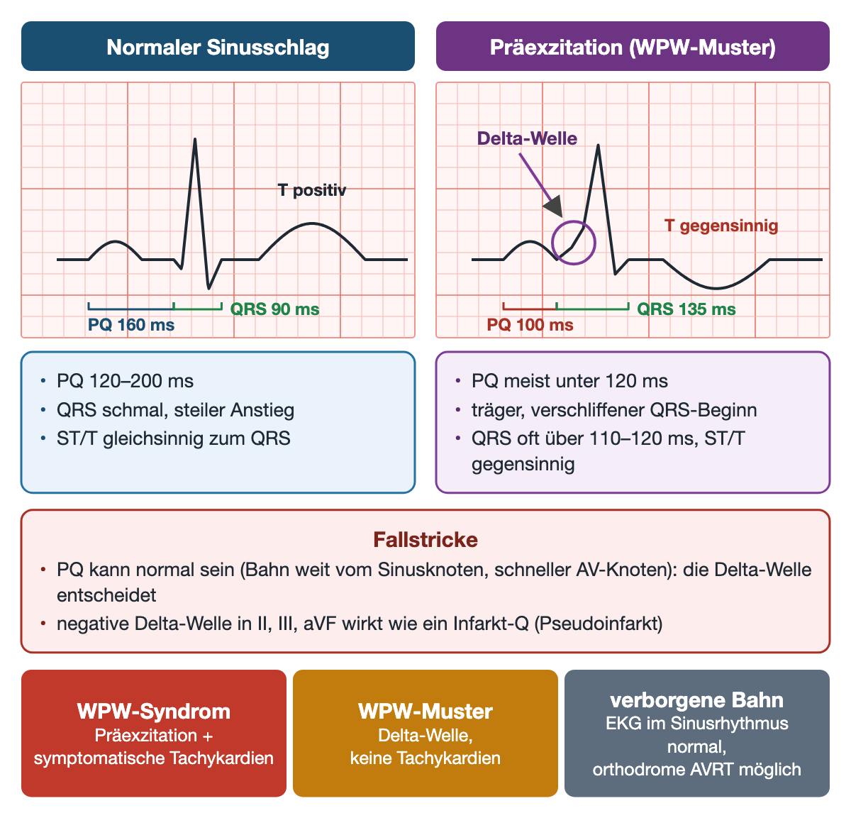 Zwei schematische EKG-Komplexe auf Millimeterpapier: links normaler Sinusschlag mit PQ 160 ms und QRS 90 ms, rechts Präexzitation mit PQ 100 ms, verschliffener Delta-Welle, QRS 135 ms und gegensinniger T-Welle; darunter Fallstricke und die Einteilung WPW-Syndrom, WPW-Muster, verborgene Bahn