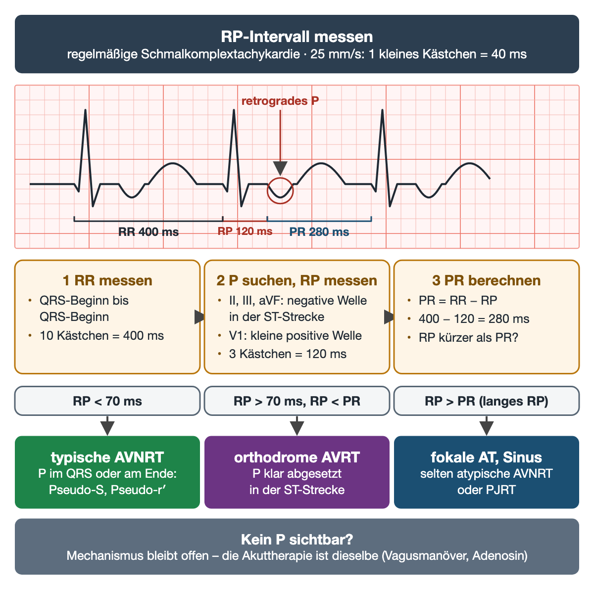 Schematischer Rhythmusstreifen auf Millimeterpapier mit RR 400 ms, retrograder P-Welle in der ST-Strecke, RP 120 ms und PR 280 ms; darunter drei Messschritte und die Zuordnung: RP unter 70 ms typische AVNRT, RP über 70 ms und kürzer als PR orthodrome AVRT, RP länger als PR fokale AT oder Sinus