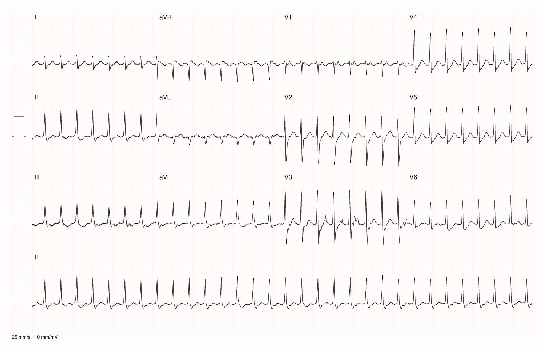 12-Kanal-EKG einer 37-jährigen Frau mit schneller, regelmäßiger Tachykardie und schmalen QRS-Komplexen