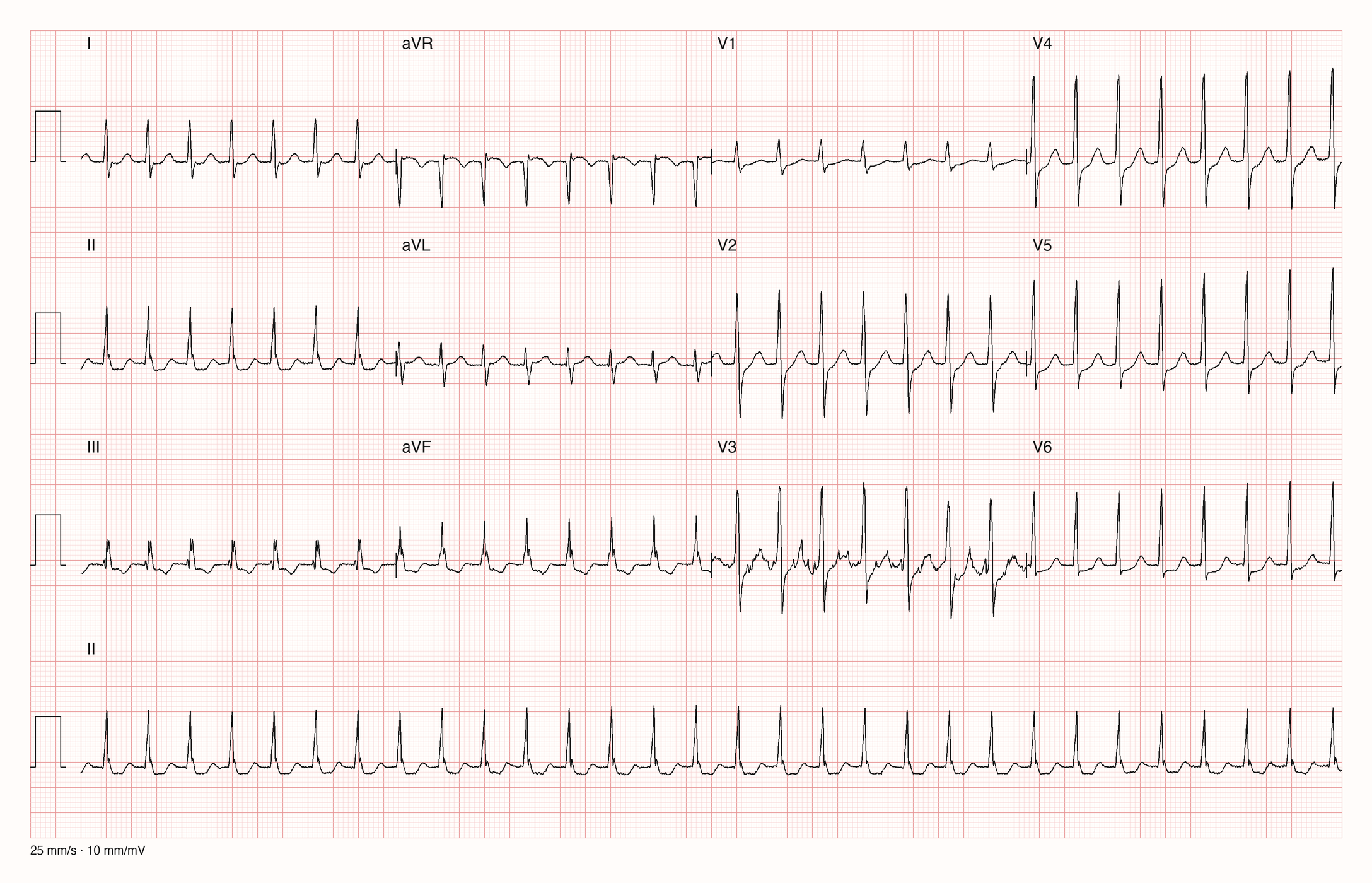 12-Kanal-EKG einer 60-jährigen Frau mit regelmäßiger schneller Tachykardie