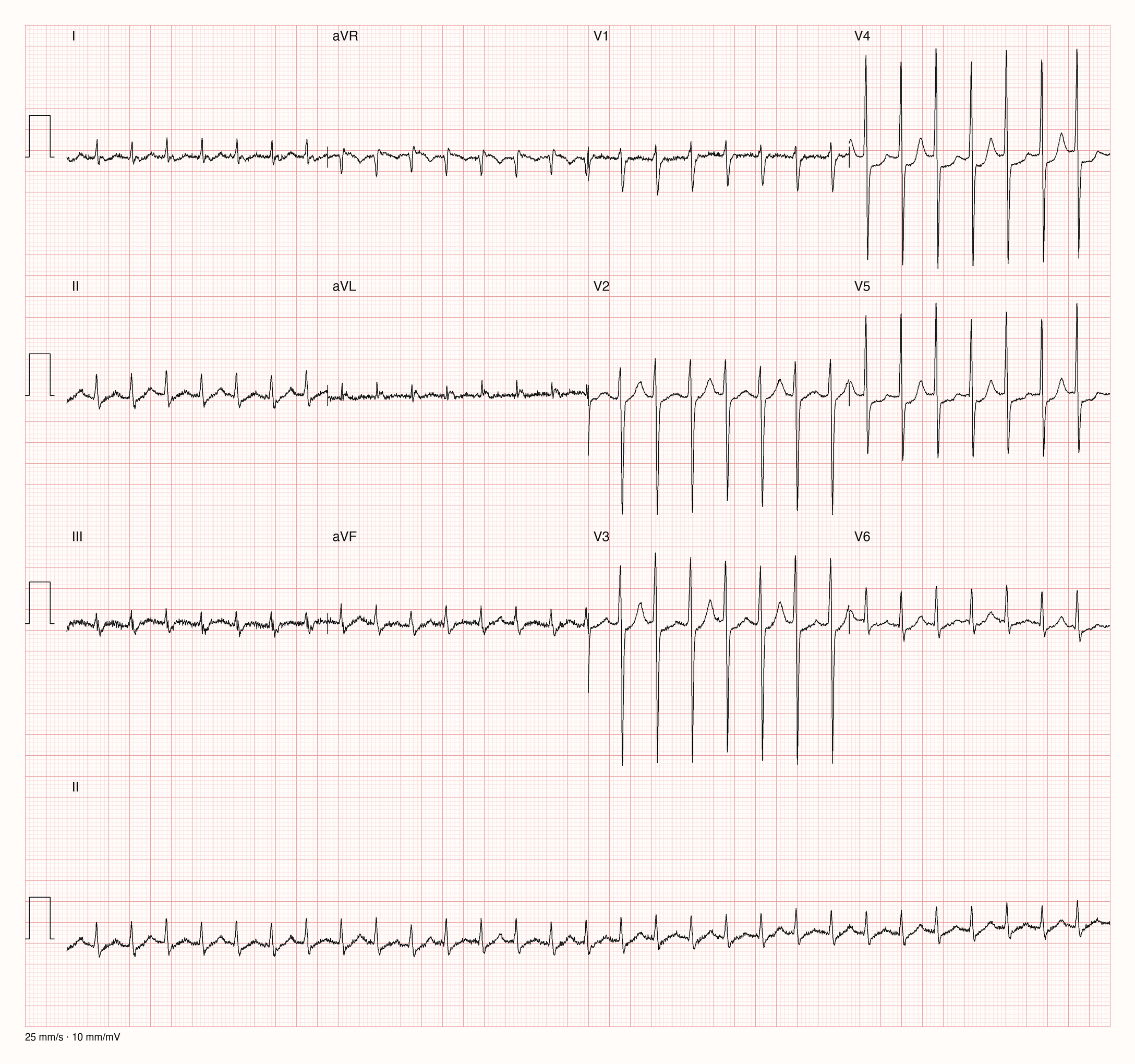 12-Kanal-EKG einer 27-jährigen Frau mit regelmäßiger schneller Tachykardie