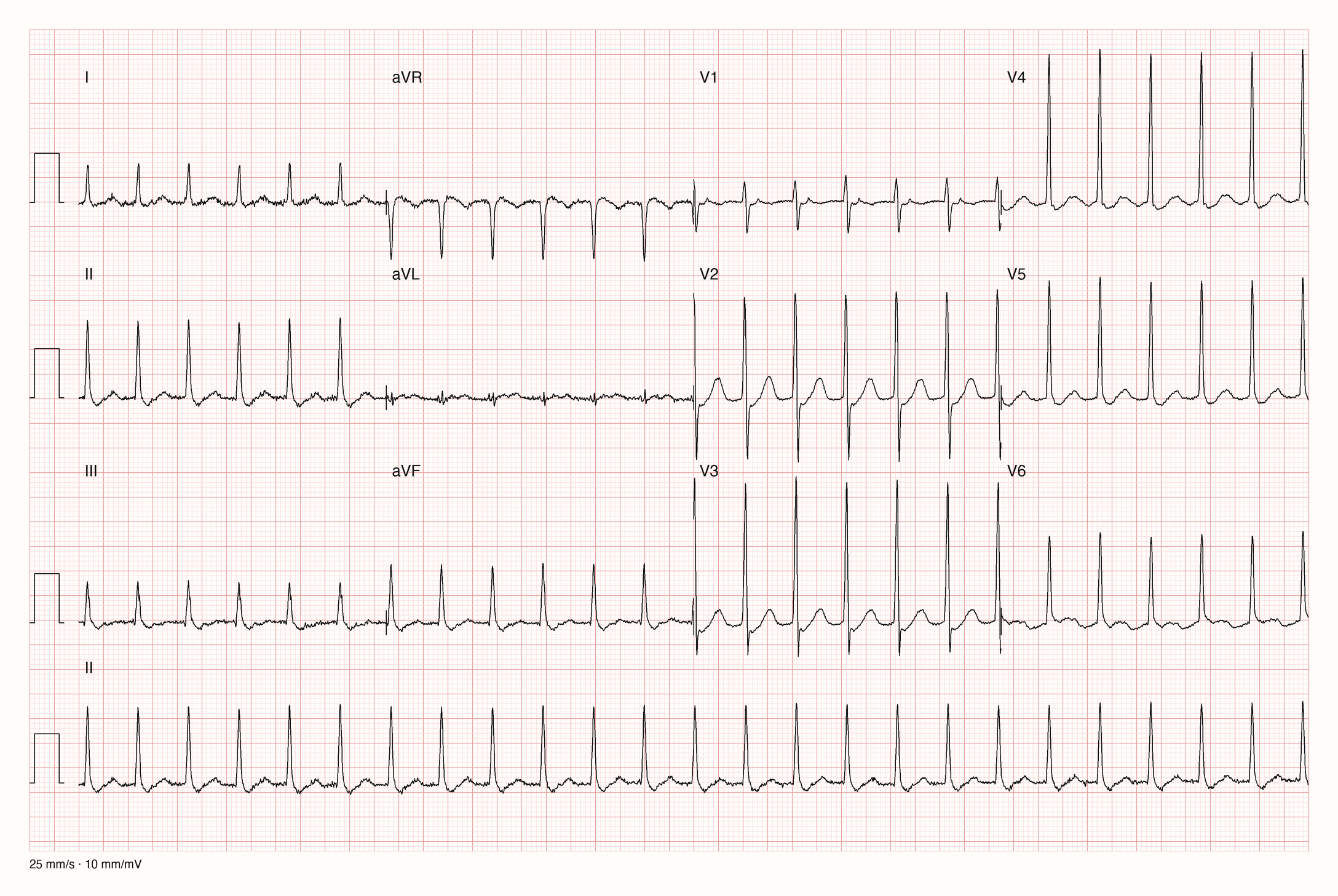 12-Kanal-EKG einer 73-jährigen Frau mit regelmäßiger Tachykardie