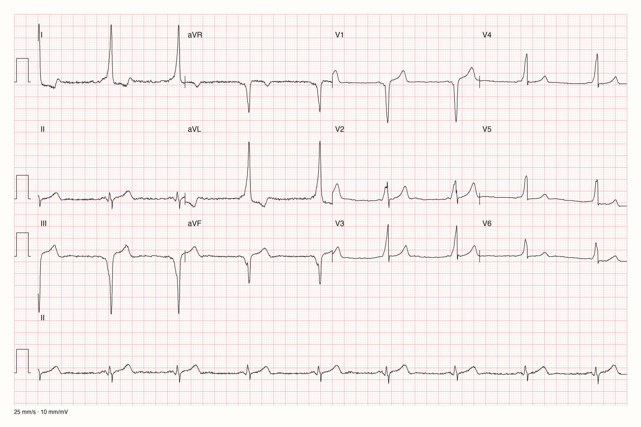 12-Kanal-EKG einer 27-jährigen Frau im Sinusrhythmus mit langsamer Herzfrequenz