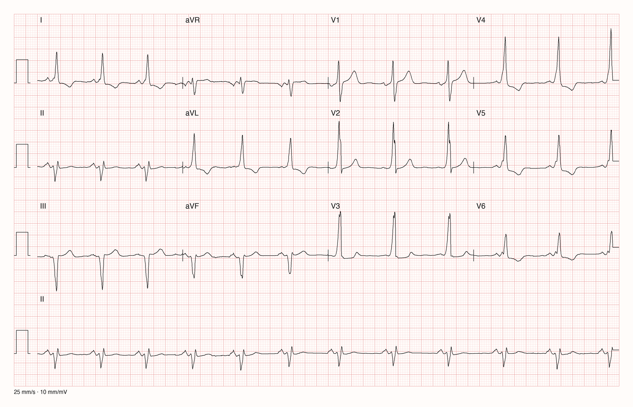 12-Kanal-EKG eines 63-jährigen Mannes im Sinusrhythmus