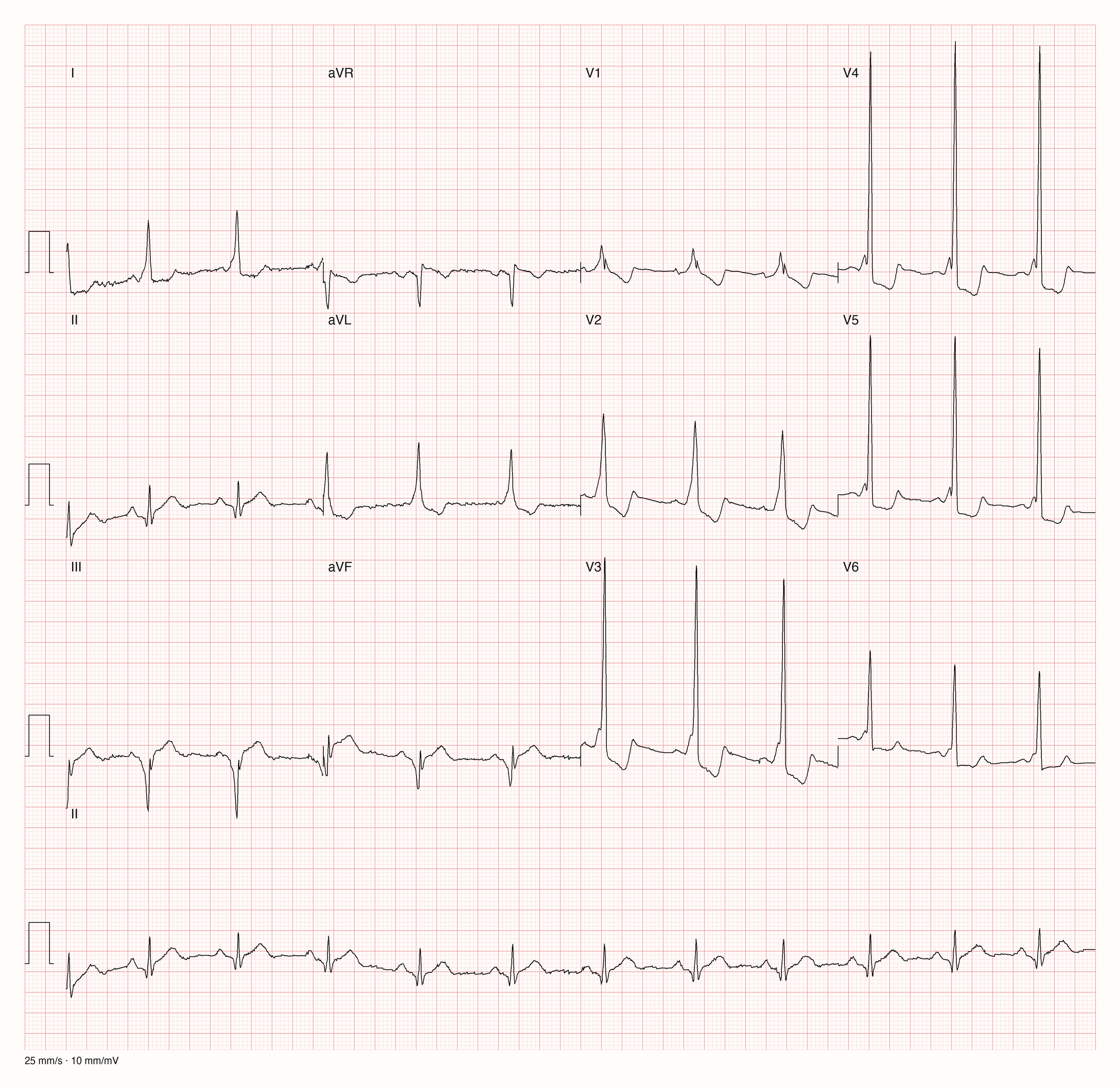 12-Kanal-EKG eines 34-jährigen Mannes im Sinusrhythmus