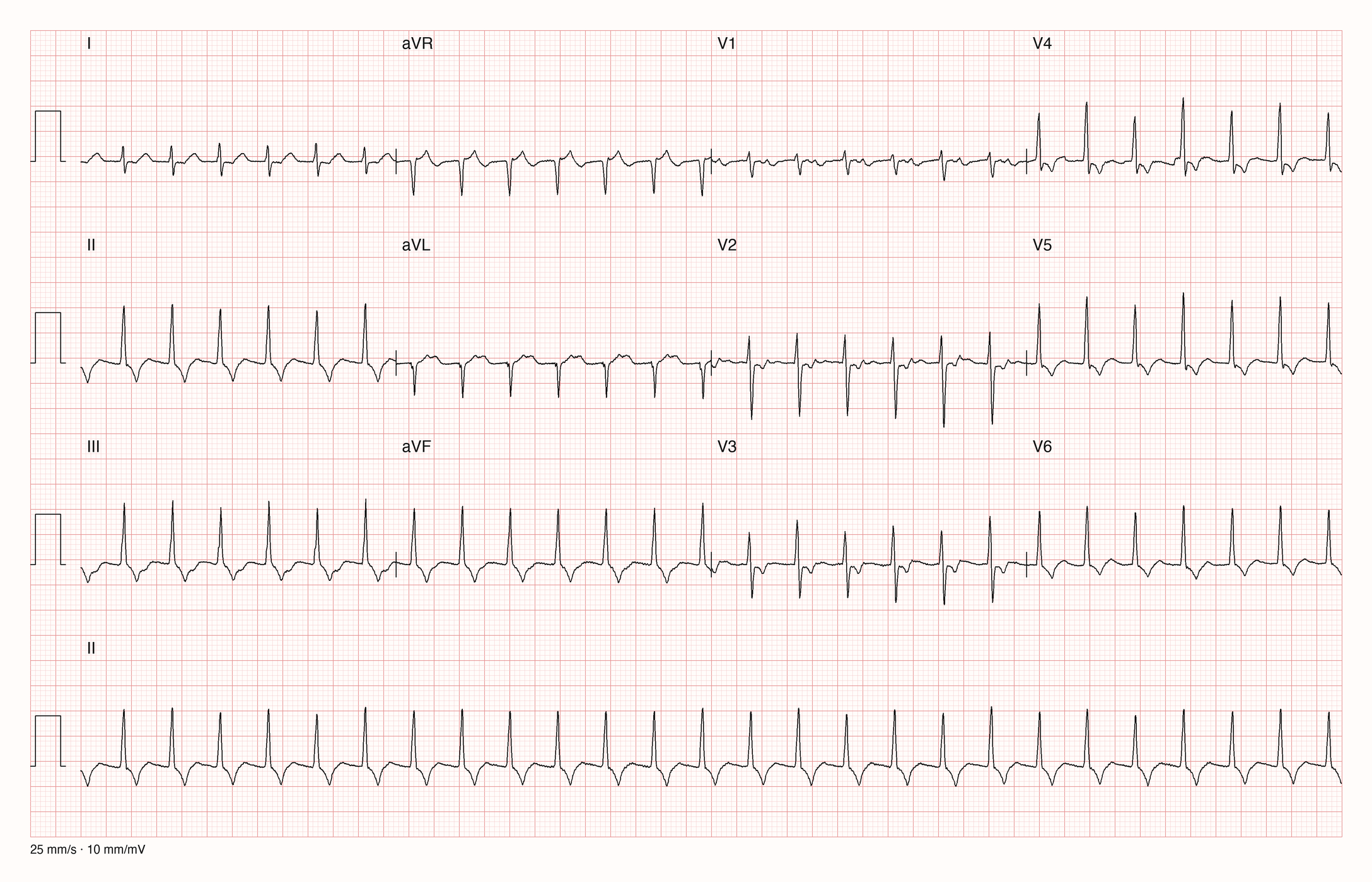 12-Kanal-EKG einer 40-jährigen Frau mit regelmäßiger Tachykardie