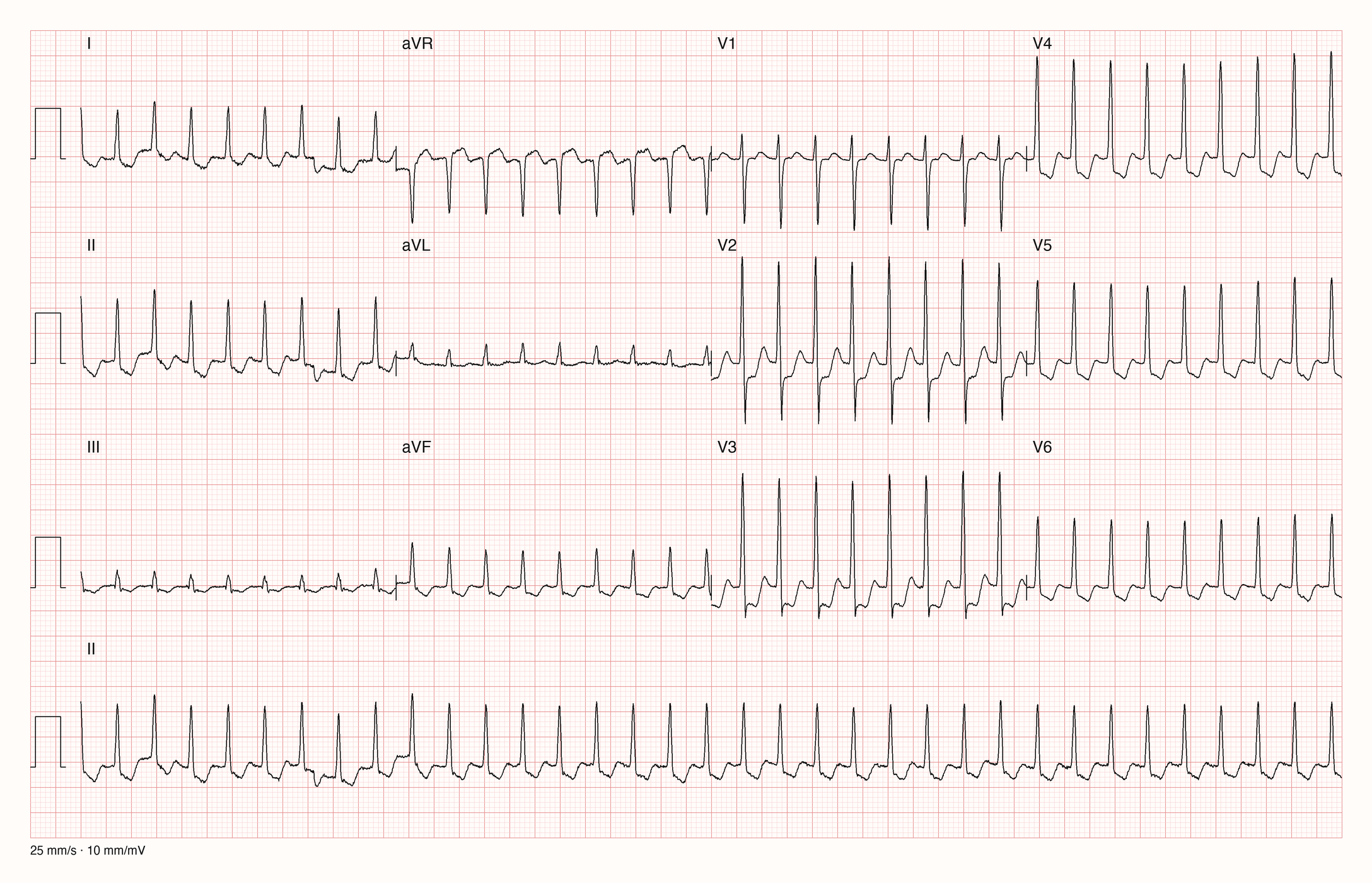 12-Kanal-EKG einer 65-jährigen Frau mit sehr schneller regelmäßiger Tachykardie