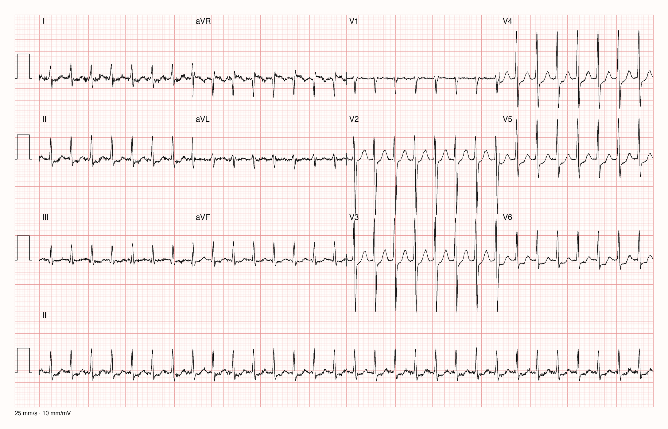 12-Kanal-EKG eines 69-jährigen Mannes mit regelmäßiger Tachykardie und unruhiger Grundlinie in den Extremitätenableitungen