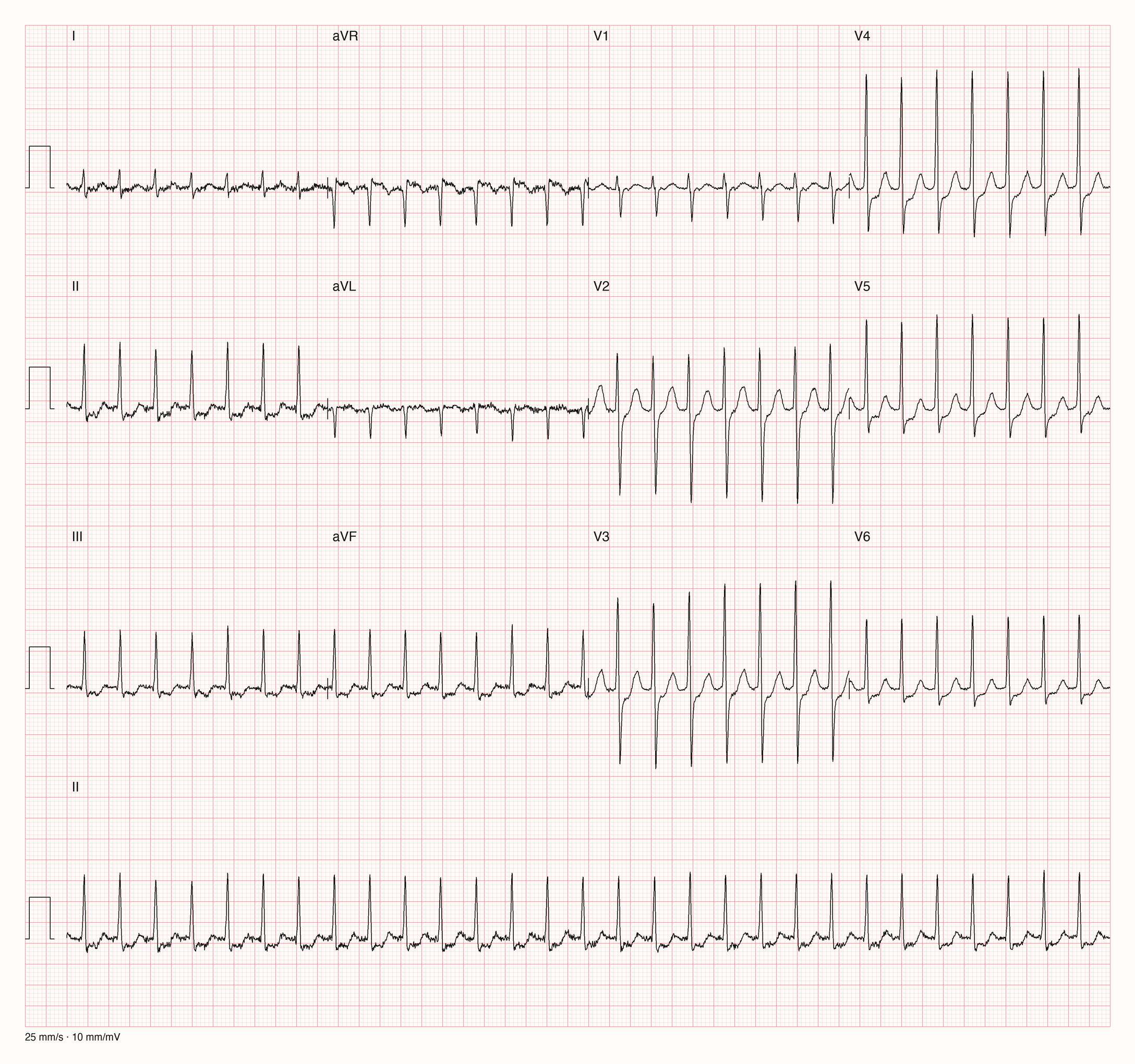 12-Kanal-EKG einer 64-jährigen Frau mit regelmäßiger Tachykardie
