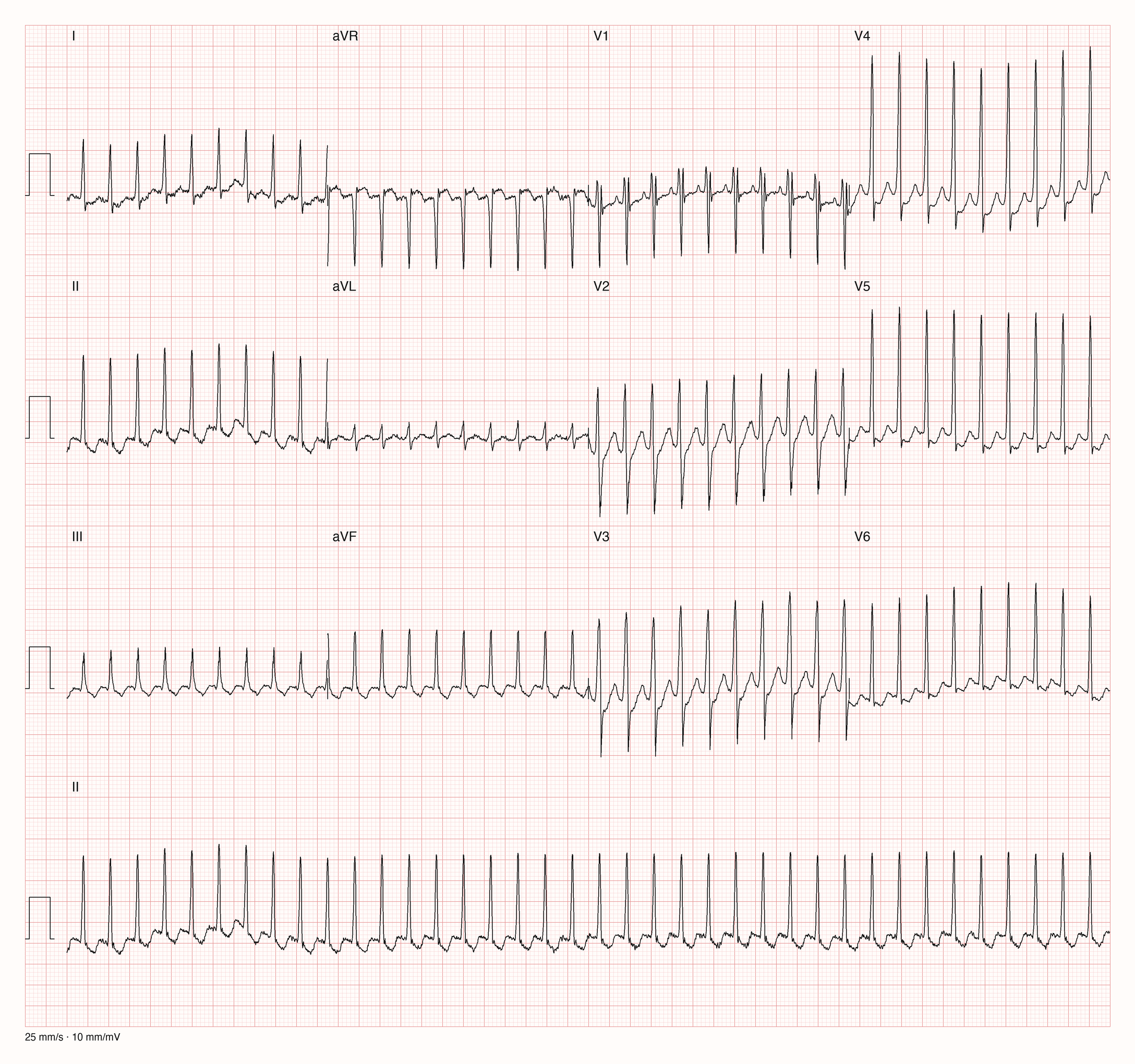 12-Kanal-EKG eines 25-jährigen Mannes mit sehr schneller regelmäßiger Tachykardie