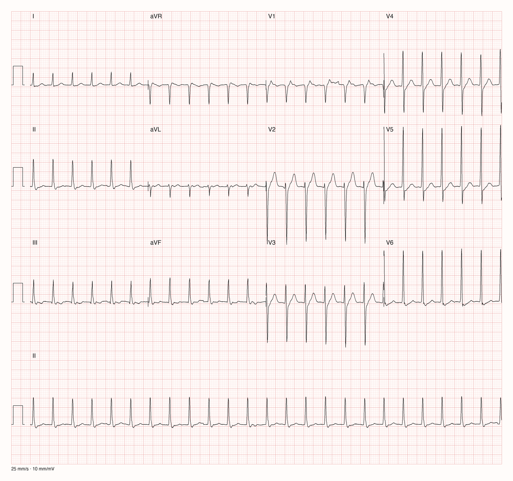 12-Kanal-EKG eines 62-jährigen Mannes mit regelmäßiger Tachykardie um 150/min und schmalen QRS-Komplexen