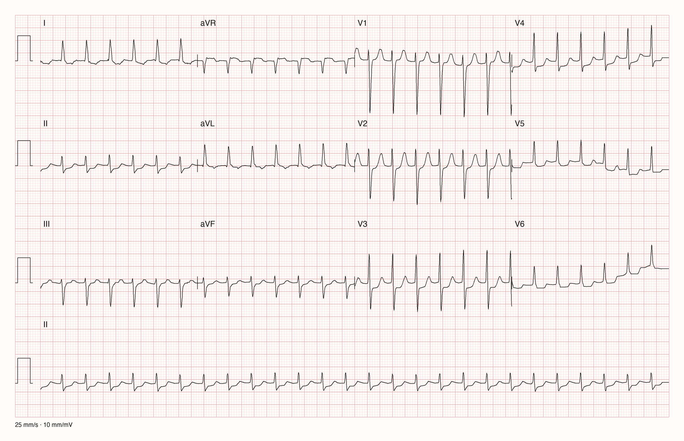 12-Kanal-EKG eines 80-jährigen Mannes mit regelmäßiger Tachykardie um 160/min