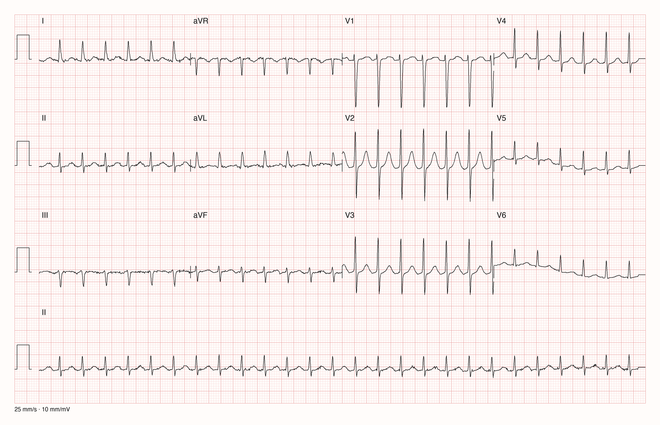 12-Kanal-EKG einer 78-jährigen Frau mit regelmäßiger Tachykardie um 160/min