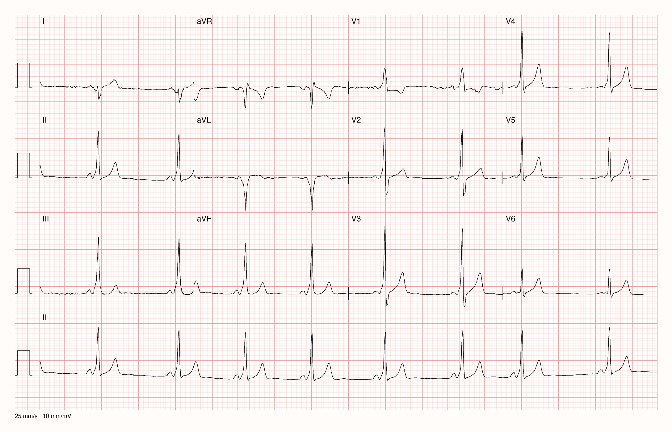 12-Kanal-EKG eines 21-jährigen Mannes im Sinusrhythmus mit langsamer Frequenz