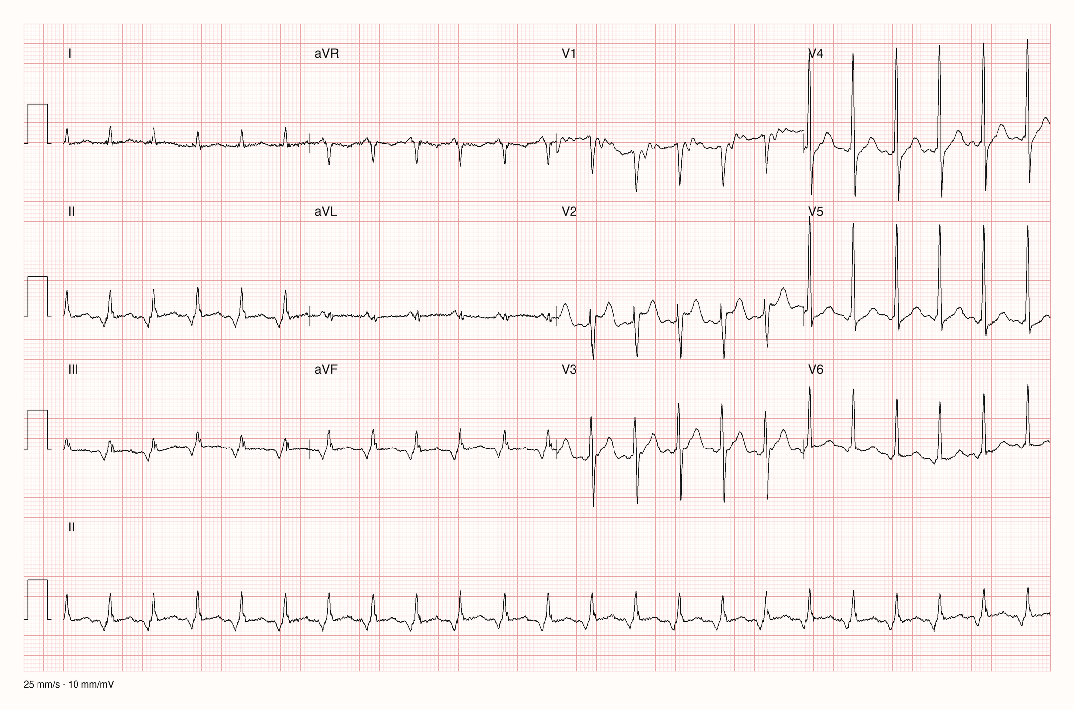 12-Kanal-EKG eines 86-jährigen Mannes mit regelmäßiger Tachykardie um 135/min
