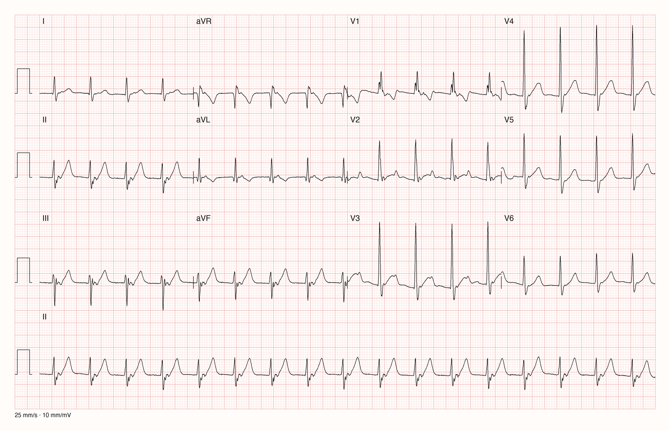 12-Kanal-EKG eines 22-jährigen Mannes mit regelmäßigem Rhythmus um 100/min