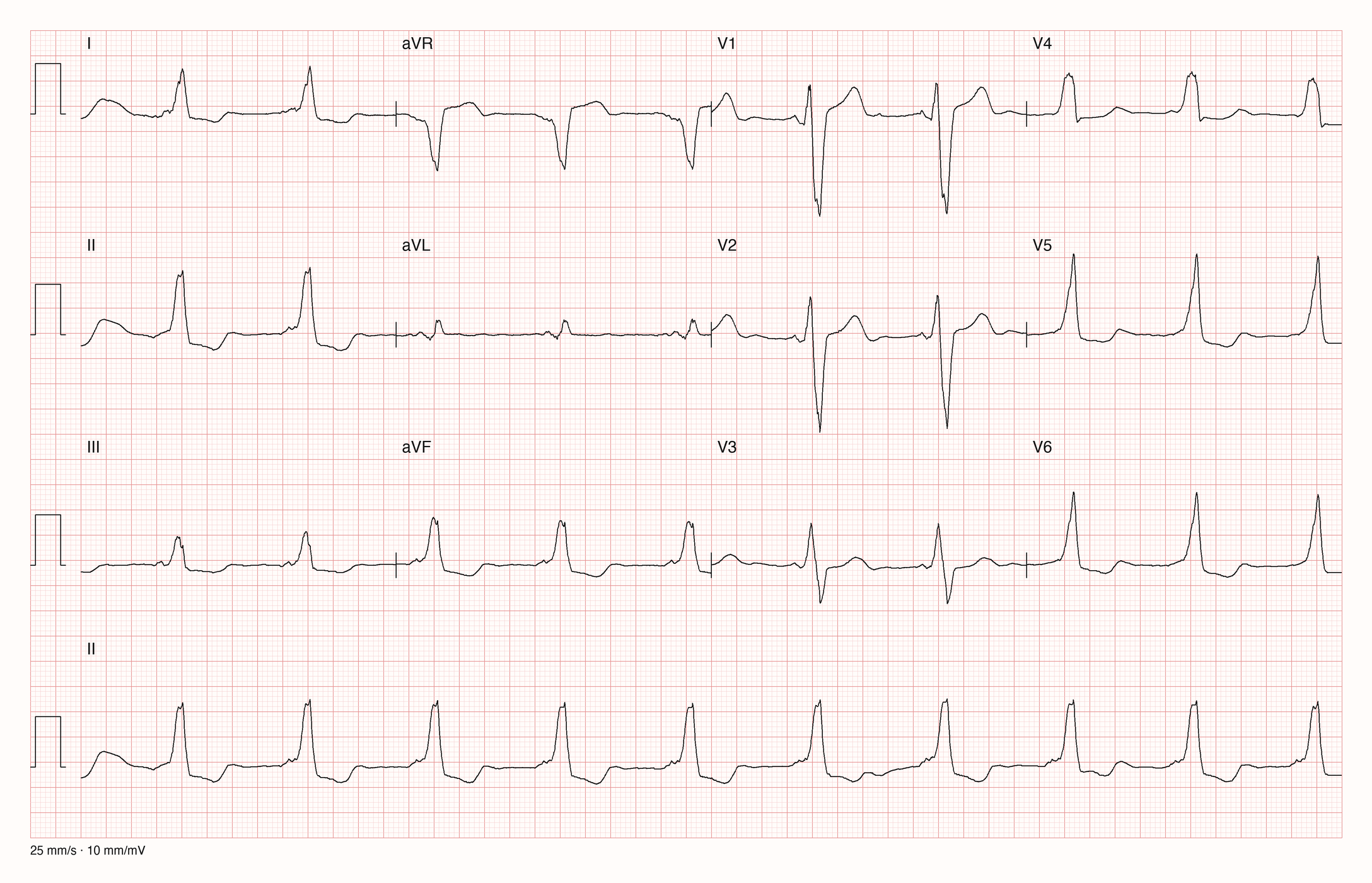 12-Kanal-EKG eines 55-jährigen Mannes im Sinusrhythmus mit breiten QRS-Komplexen