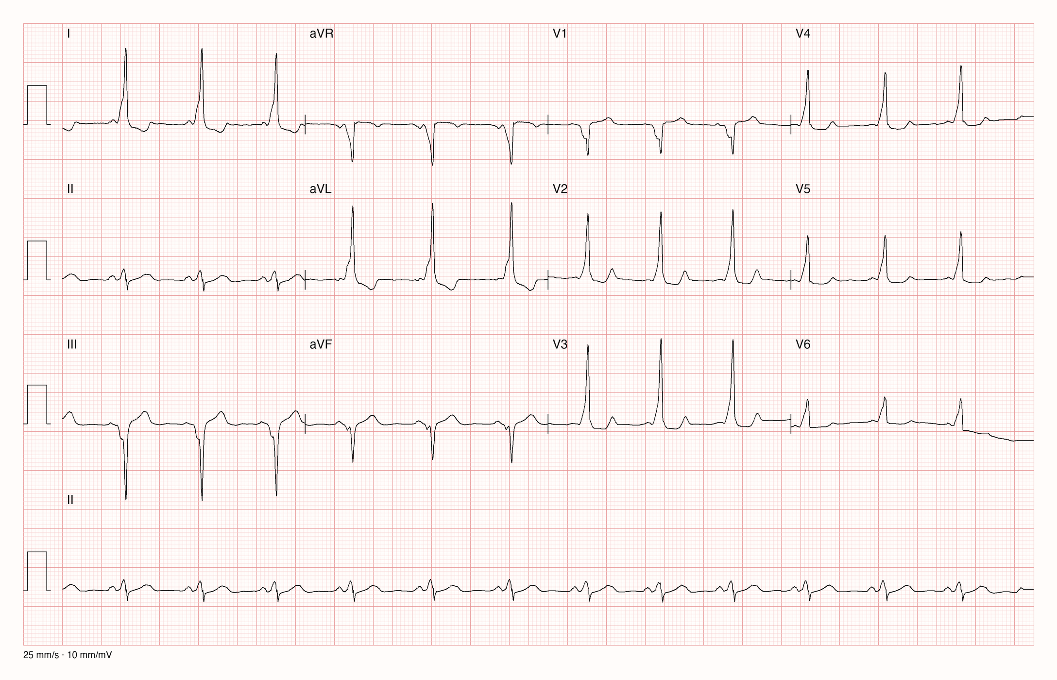 12-Kanal-EKG einer 55-jährigen Frau im Sinusrhythmus