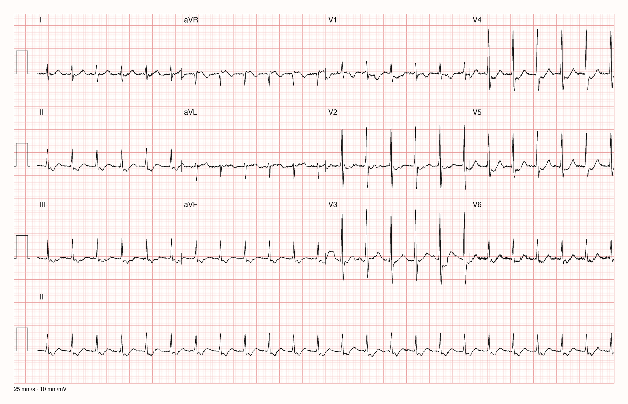 12-Kanal-EKG einer 63-jährigen Frau mit regelmäßiger Tachykardie um 140/min