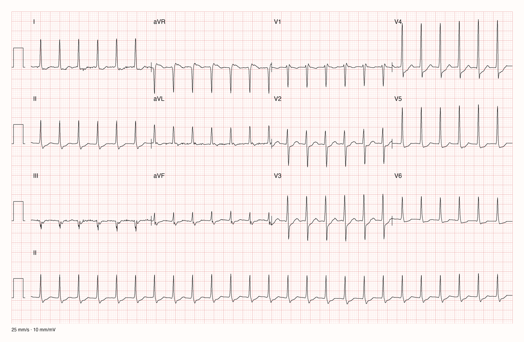 12-Kanal-EKG eines 73-jährigen Mannes mit regelmäßiger Tachykardie um 150/min