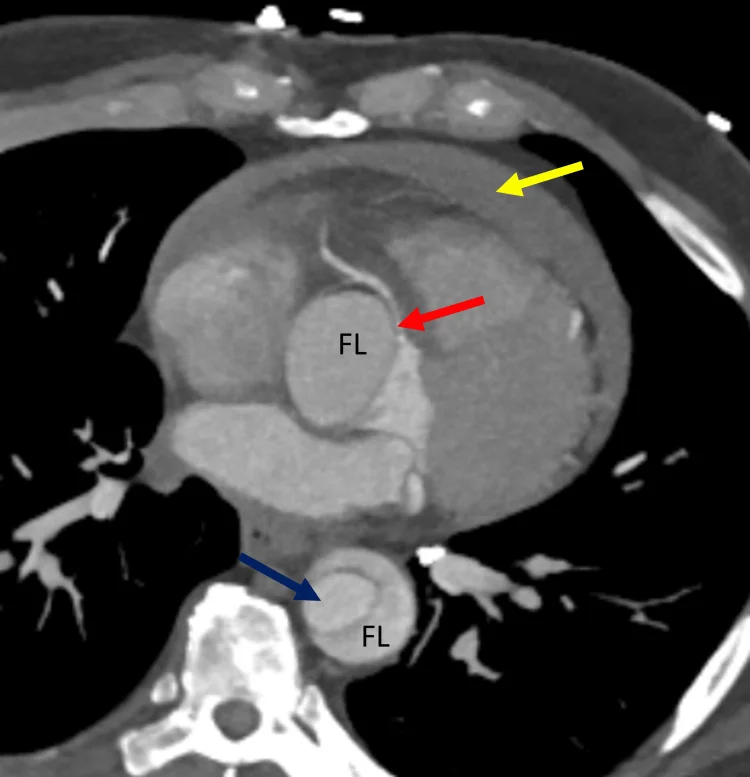 Axiales Kontrastmittel-CT des Thorax: Dissektionsmembran in der Aorta ascendens und descendens, jeweils mit FL für falsches Lumen beschriftet; farbige Pfeile auf Membran, Koronarabgang und Perikarderguss.