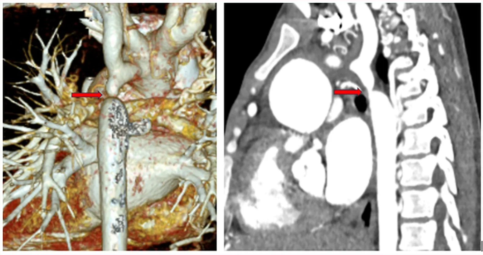 CT-Angiographie der Brustaorta, links 3D-Rekonstruktion, rechts sagittale Schicht: Rote Pfeile zeigen auf eine kurze, hochgradige Einengung der Aorta descendens kurz nach dem Abgang der linken A. subclavia; geschlängelte Kollateralgefäße liegen um die Engstelle.
