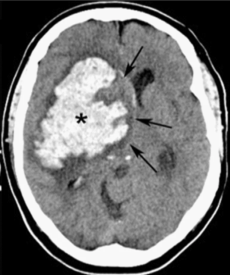 Axiales Nativ-CT des Kopfes: große hyperdense Blutung in den rechten Stammganglien, mit Stern markiert; Pfeile am medialen Blutungsrand, der rechte Seitenventrikel ist eingeengt.