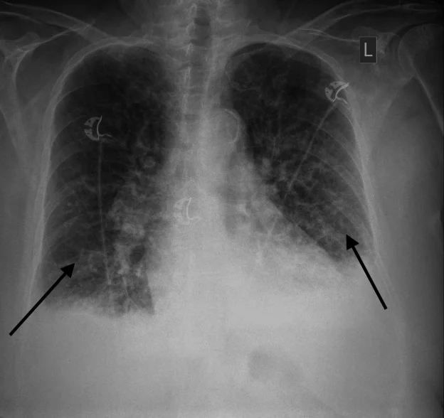 Röntgen-Thorax im Sitzen am Bett: beidseits vermehrte, unscharfe Lungengefäßzeichnung und basale Verschattungen mit beidseitigen Pleuraergüssen; zwei Pfeile zeigen auf die basalen Lungenabschnitte.