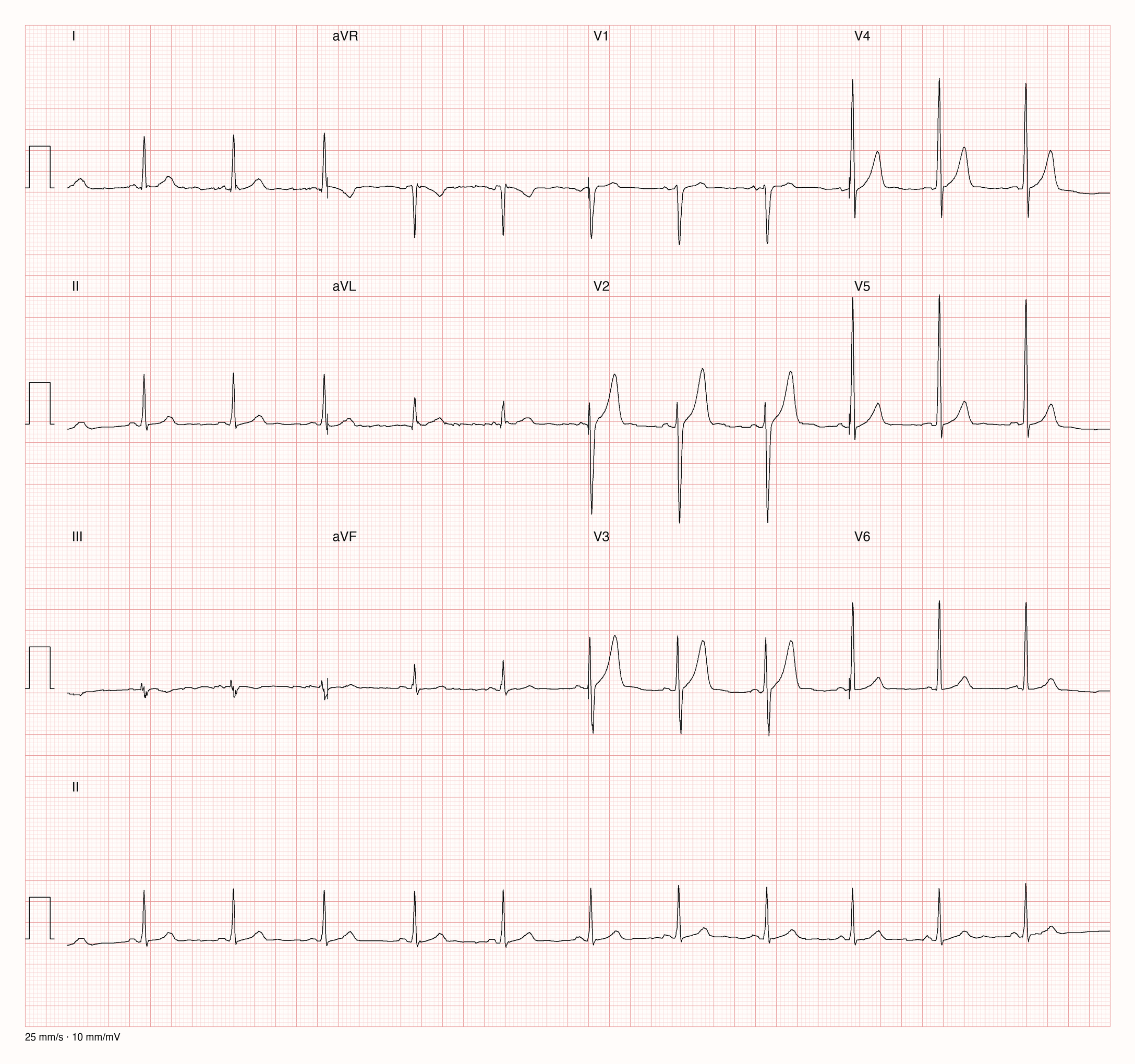 Reales Zwölf-Kanal-EKG mit zusätzlichem langem II-Streifen; 25 Millimeter pro Sekunde und 10 Millimeter pro Millivolt.