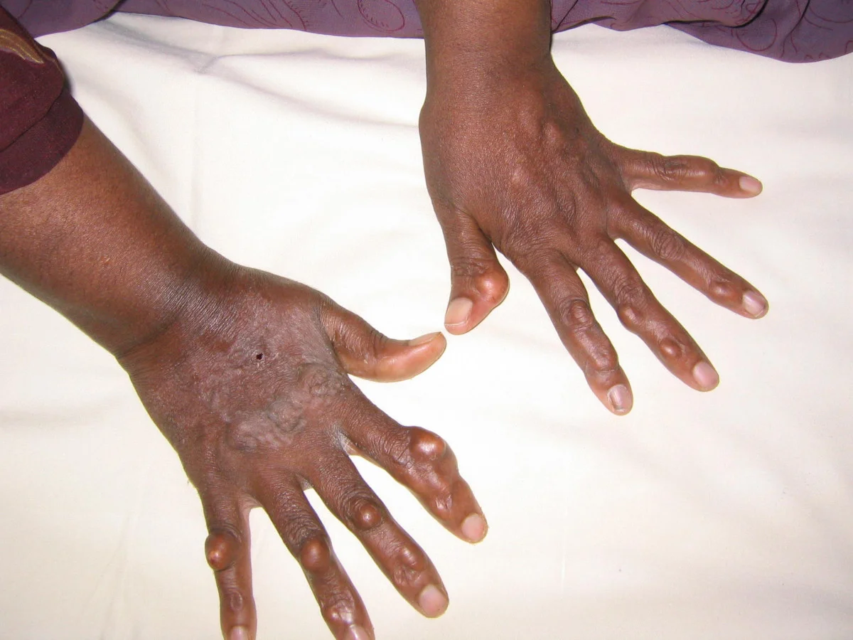 Beide Handrücken einer jungen Patientin mit mehreren derben, hautfarbenen Knoten über den Fingergelenken und Sehnen; an einem Handrücken zusätzlich eine flächige, gelblich-bräunliche Erhabenheit.