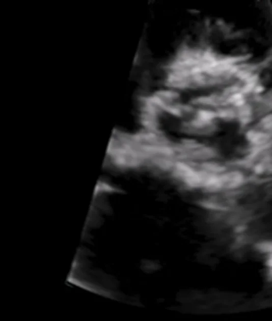 Ultraschallquerschnitt in Graustufen: in der Bildmitte ein rundlicher Klappenring mit sehr hellen, verdickten, unregelmäßigen Taschen und nur schmalen dunklen Lücken dazwischen