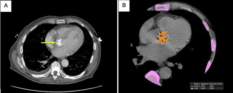 Zwei axiale CT-Schnitte durch das Herz: links eine helle, verkalkte Aortenklappe mit gelbem Pfeil, rechts dieselbe Verkalkung orange markiert