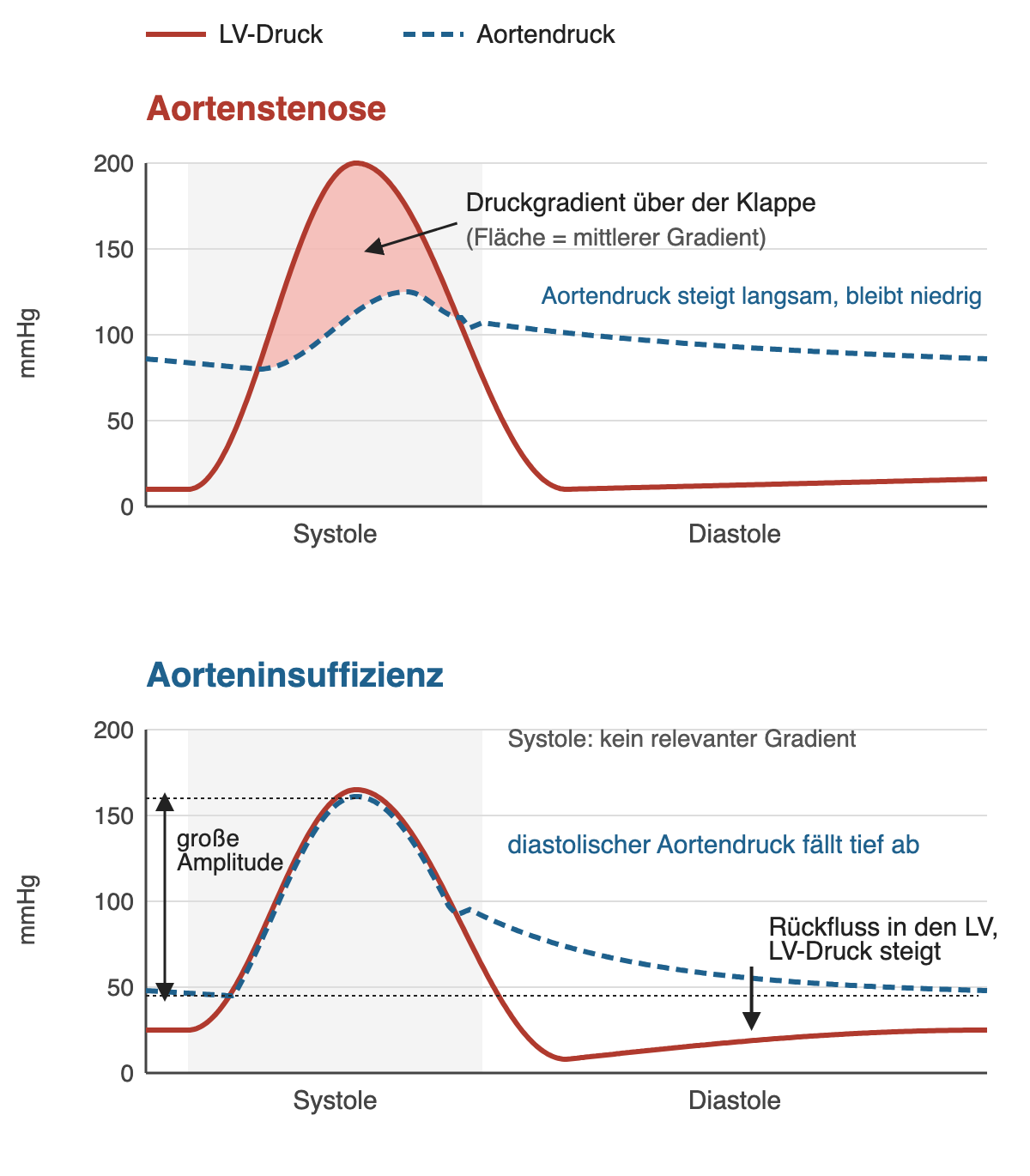 Schematische Druckkurven von LV und Aorta: bei Aortenstenose ein großer systolischer Gradient, bei Aorteninsuffizienz eine große Blutdruckamplitude mit tiefem diastolischem Aortendruck