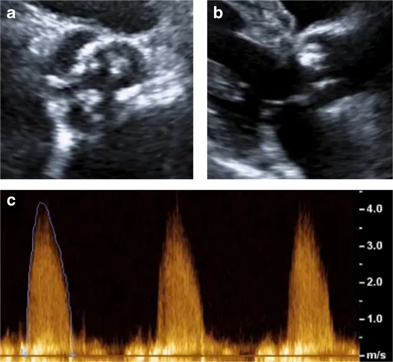 Drei Echokardiografie-Bilder: oben eine Aortenklappe im Querschnitt mit hellen Kalkherden und eine Längsachse mit verkalkter Tasche, unten ein CW-Doppler-Spektrum mit Spitzen über 4 m/s