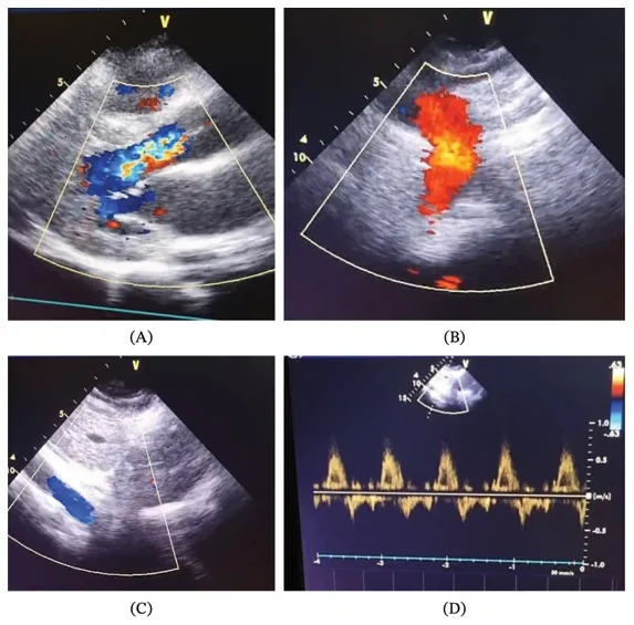 Vier Echokardiografie-Bilder: ein breiter bunter Rückflussstrahl unter der Aortenklappe, Farbsignale in der Aorta descendens und der Bauchaorta sowie ein Doppler-Spektrum mit Fluss in der ganzen Diastole