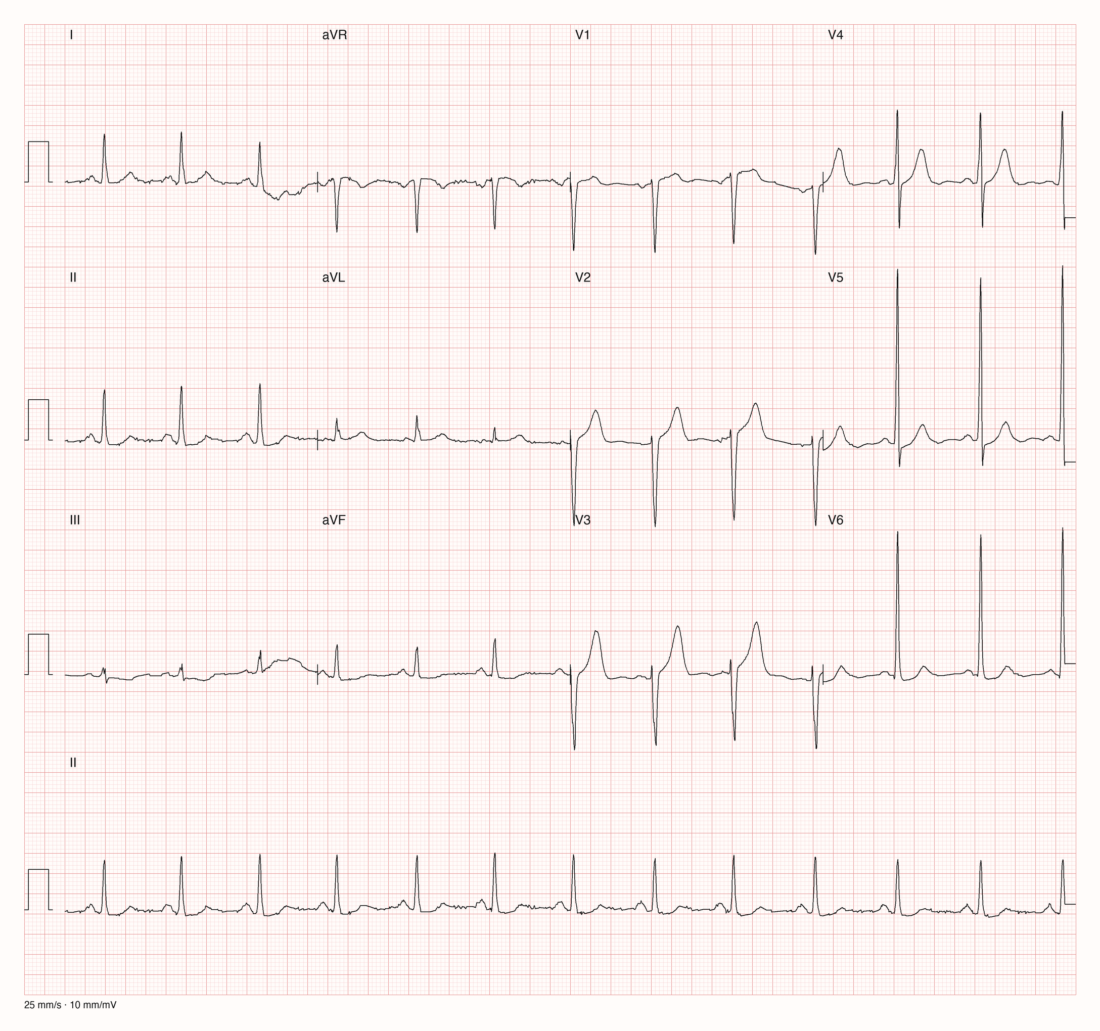12-Kanal-EKG mit sehr hohen R-Zacken in V5 und V6, tiefen S-Zacken in V1 bis V3 und leichter ST-Senkung lateral