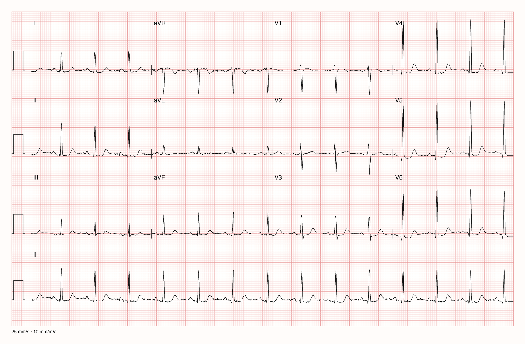 12-Kanal-EKG mit hohen R-Zacken in V4 bis V6 und leichten ST-Senkungen