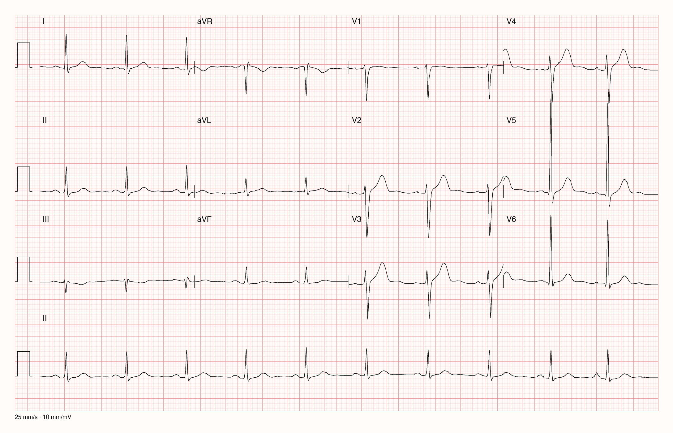 12-Kanal-EKG mit hohen R-Zacken in V5 und V6, tiefen S-Zacken in V1 bis V4 und unauffälligen T-Wellen