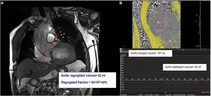 Kardio-MRT mit roter Schnittlinie über der Aortenklappe, daneben ein Phasenkontrastbild der Aorta und eine Flusskurve mit großem positivem und negativem Anteil
